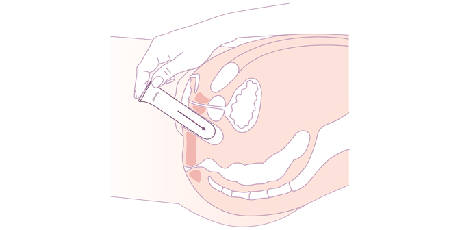 utilisation dilatateur taille 6 vaginoplastie